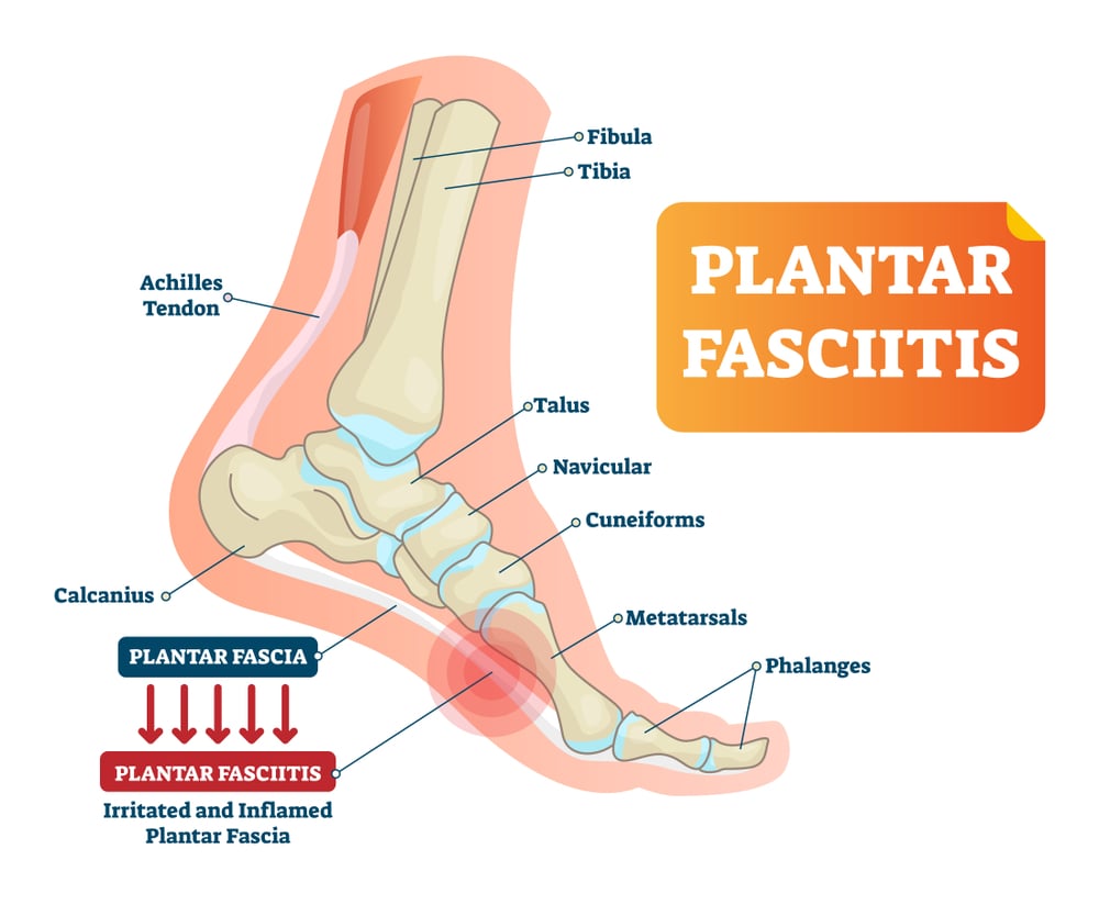 Plantar Fasciitis Markham